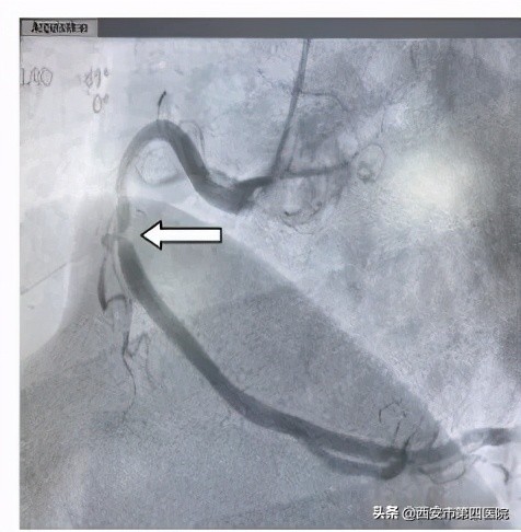 我院完成首例冠脉介入治疗,你是我的眼睛医院