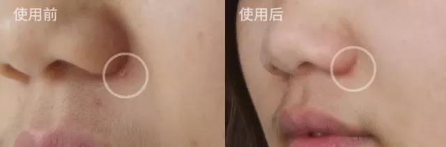 全网最好用的祛痘产品,祛痘产品最良心测评