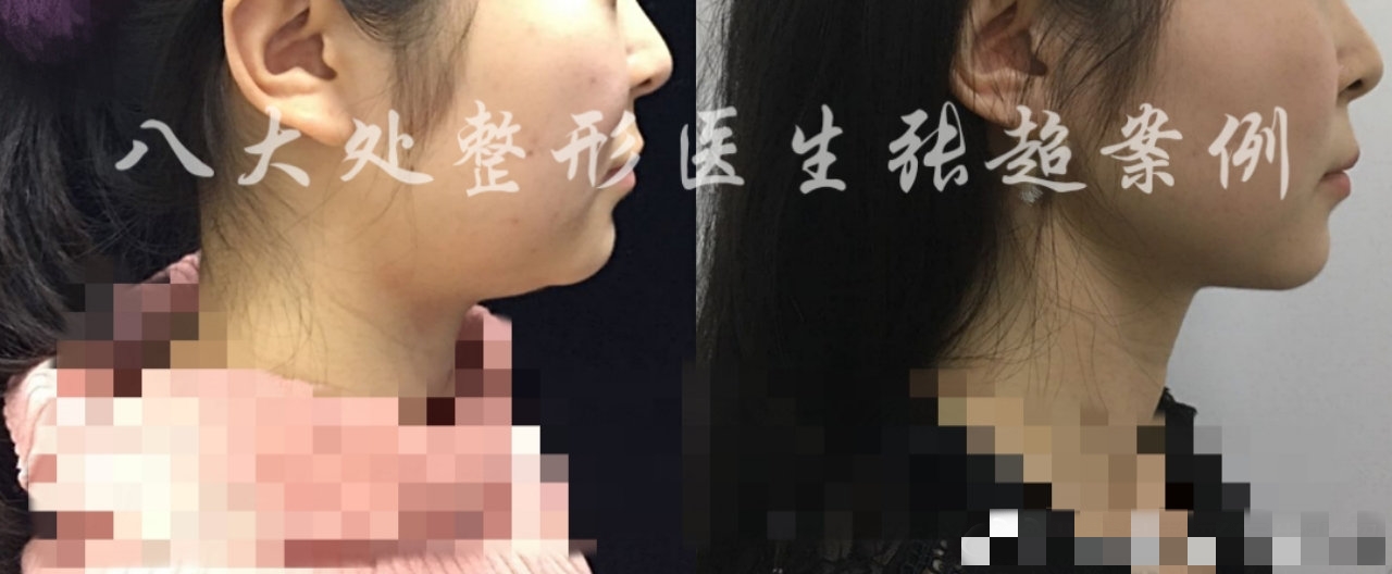 八大处整形张超,八大处张超最新视频