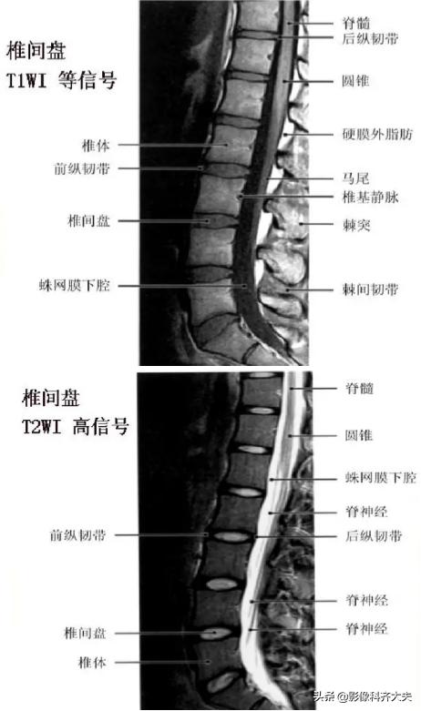 腰椎间盘突出是什么,腰椎间盘突出和腰间盘突出有区别吗