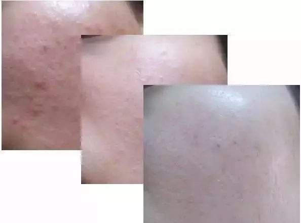 女士夏季去痘印毛孔堵塞贴面膜,脸上痘印怎么最快淡化小窍门