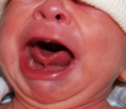 4岁舌系带过短要不要剪,什么是舌系带短图片