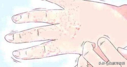 手上起红疹子是湿疹还是痱子,手上起癣湿疹是怎么治