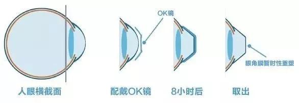 孩子还没近视怎么控制预防近视 (孩子近视越来越严重如何有效控制)