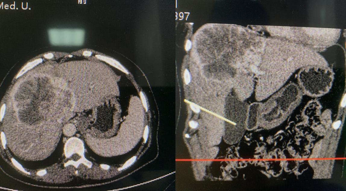 外科手术珠穆朗玛峰,肝胆外科的珠穆朗玛峰
