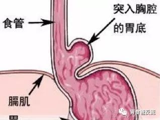 胃溃疡和反流性食管炎哪个难治,为什么反流性食管炎难治