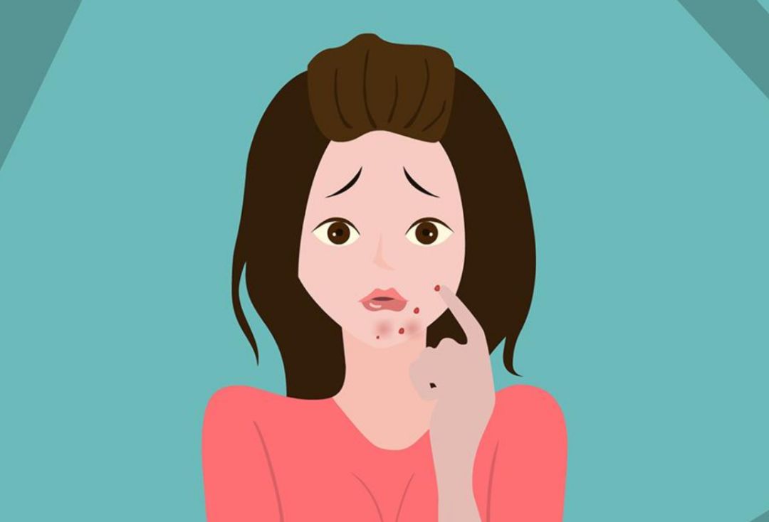 下巴长痘痘的正确消除方法吃什么,下巴长痘的10大调理的方法