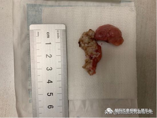 扁桃体腺样体切除后什么时间最痛,扁桃体切除后白膜脱落时更痛了