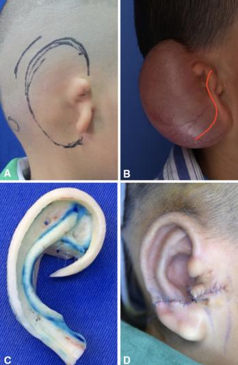耳再造一期扩张手术过程,耳再造手术北京好还是上海好呢
