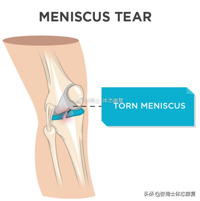 【运动康复科普】为什么你的膝关节内侧会出现疼痛？