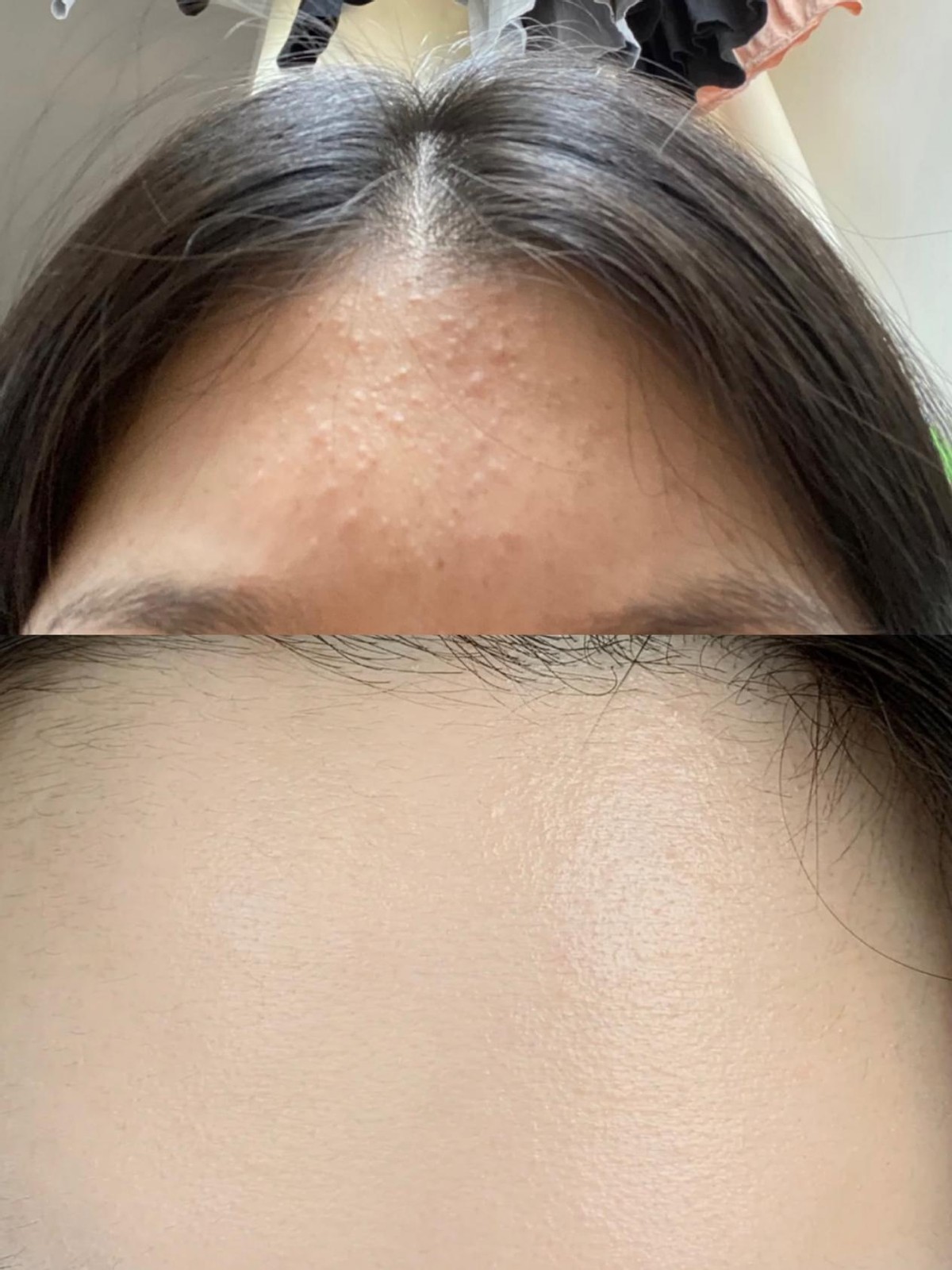 怎么才能彻底让脸上的闭口消失,如何去闭口最有效的方法