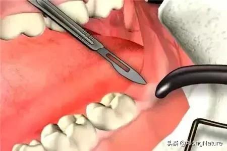 高血压糖尿病经常牙疼牙龈肿痛,牙龈经常无缘无故肿痛导致牙疼