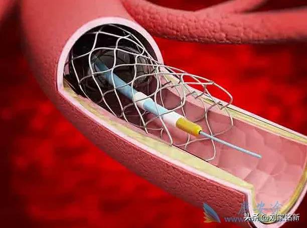 冠心病支架术后用药,冠心病支架术后心脏康复科普