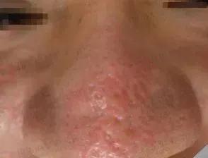 听说你毛孔大到可以放芝麻，该怎么办？