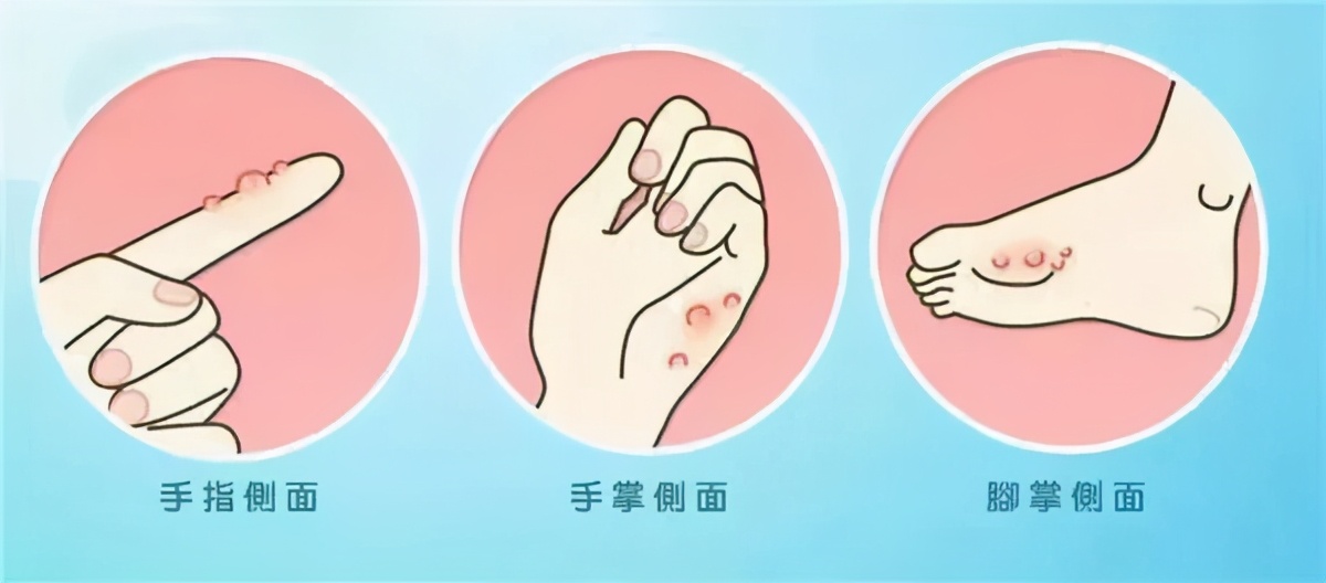 汗疱疹觉得痒怎么办,汗疱疹是不是都会痒