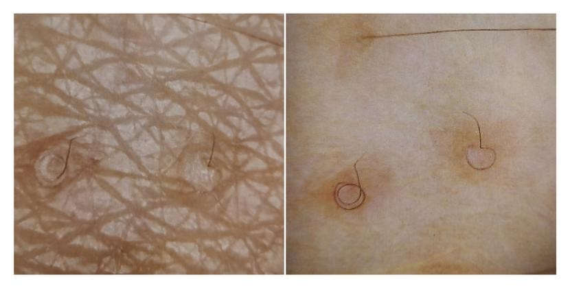 长汗毛导致的鸡皮肤怎么办,女生有鸡皮肤的解决方法