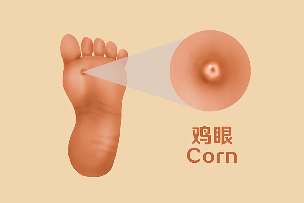 脚上长了鸡眼怎么能快速的去掉,脚上长鸡眼怎么去除鸡眼
