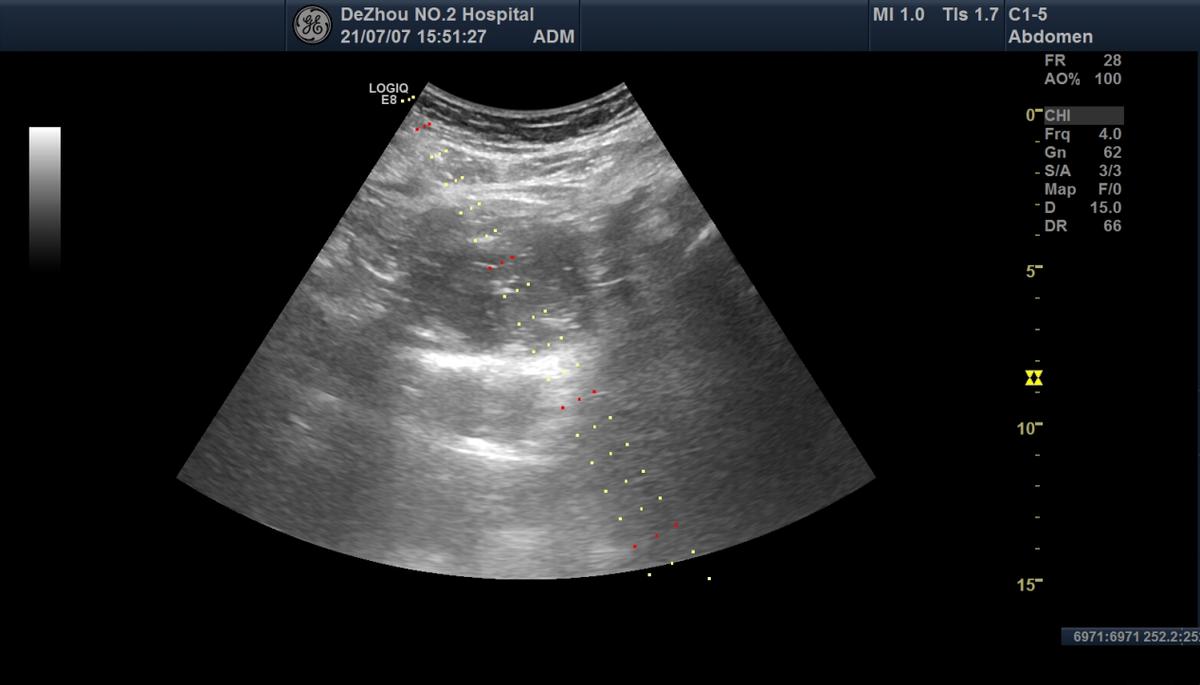 卵巢畸胎瘤和巧克力囊肿,未婚女性卵巢巧克力囊肿