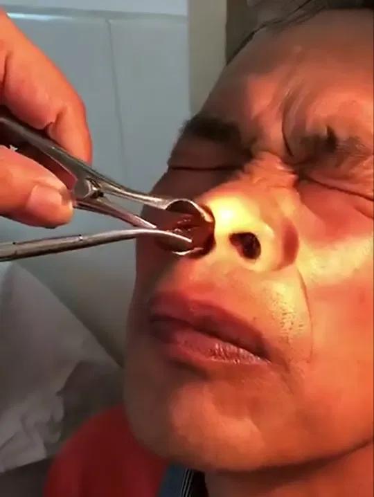 男孩被蚂蚁吓死,蚂蝗寄生在五岁男孩身体里一年