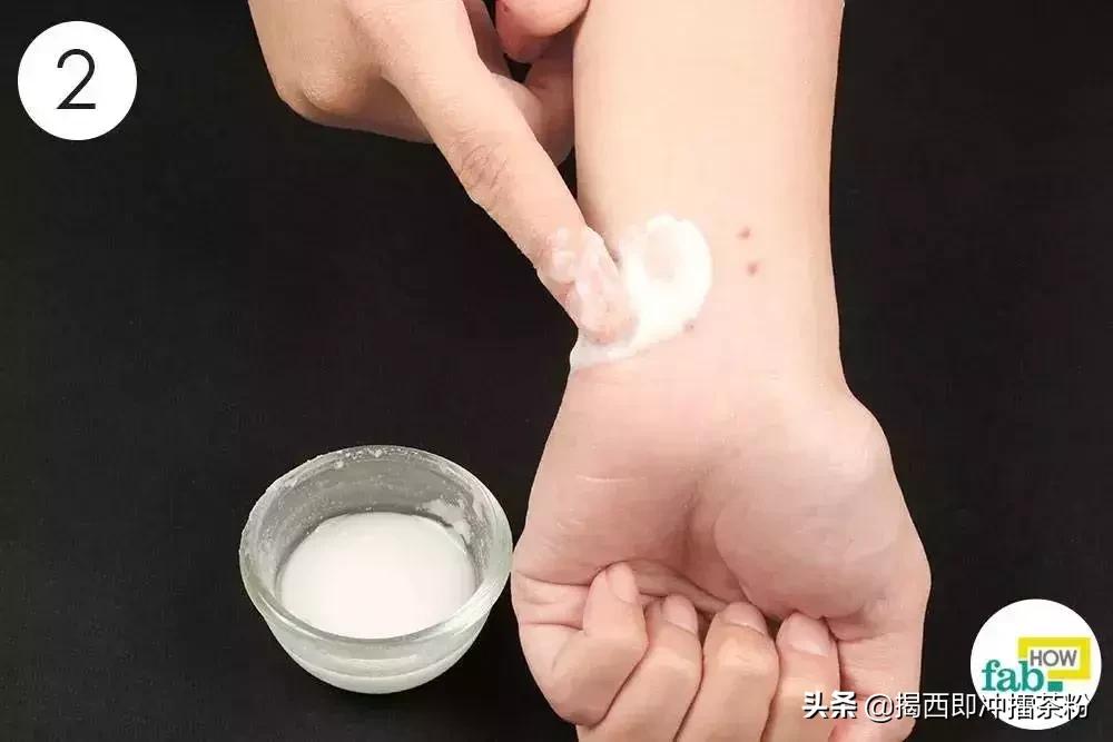 被蚊子咬了可以涂丁酸氢化可的松,被蚊子咬了但什么都没带