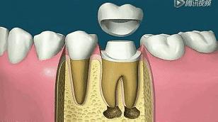 根管治疗第四步骤,根管治疗案例分享话术