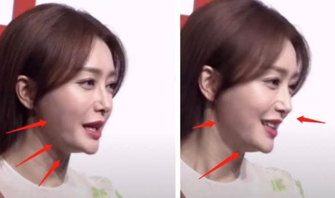 那些削骨的女明星怎么样了,哪些明星承认削骨了