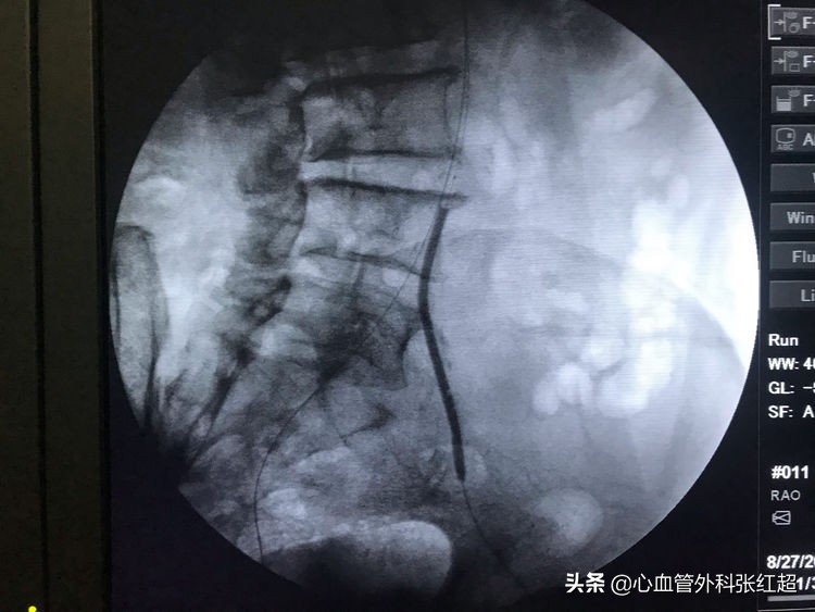 外周血管治疗图,外周血管疾病怎么治