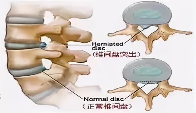 椎间盘突出按摩好还是牵引好,腰椎5骶1椎间盘突出可以按摩吗