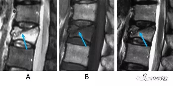 9种椎体和椎旁信号增高的非肿瘤性病变