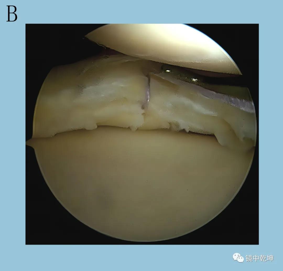 南大二附院系列科普：关节镜手术治疗膝关节半月板损伤