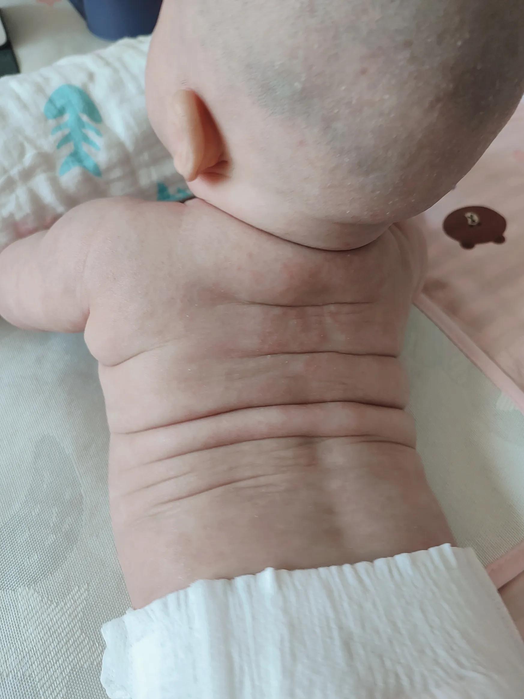 根治湿疹特效药,宝宝湿疹大作战图文