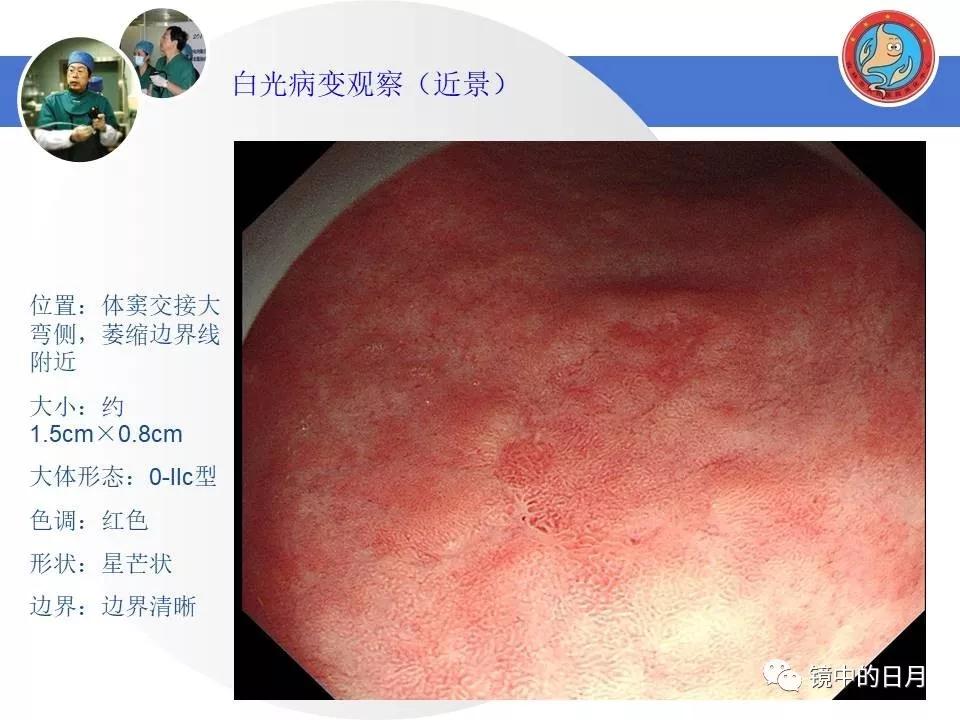 低分化胃癌早期时候做内镜手术吗,早期胃癌内镜手术后追加外科手术