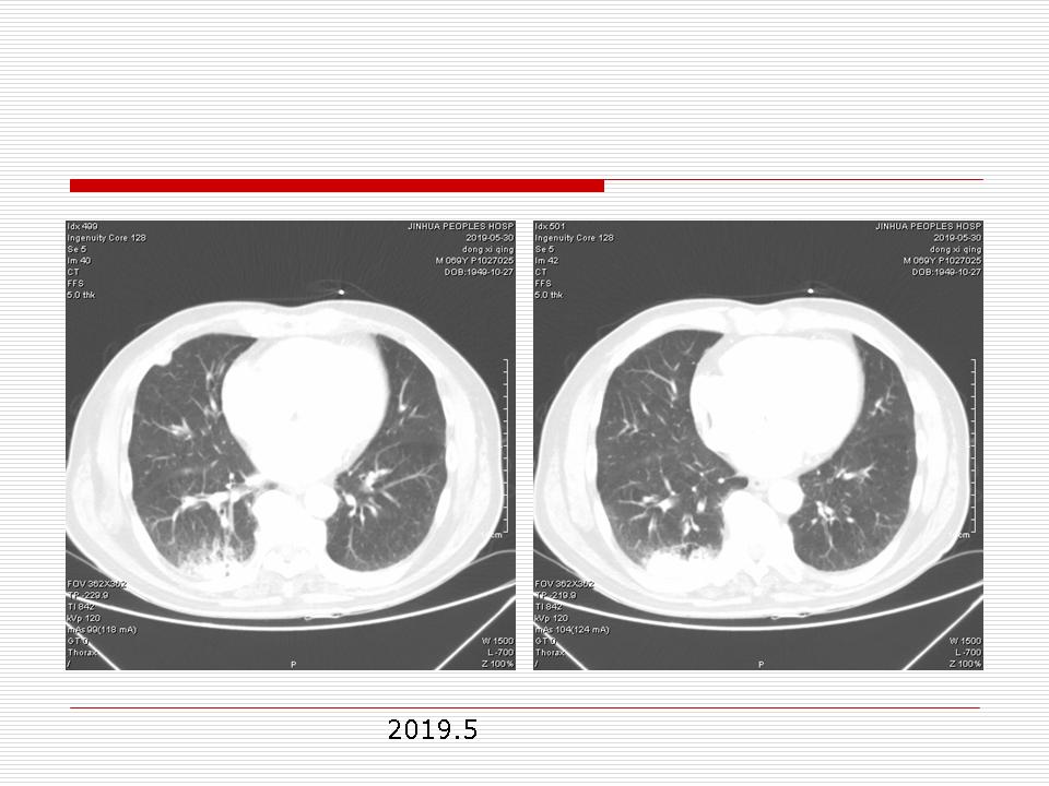 像炎症的肺癌能治好吗,医生说可能是肺癌也可能是炎症