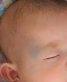 皮秒太田痣激光恢复过程,治疗太田痣费用贵吗