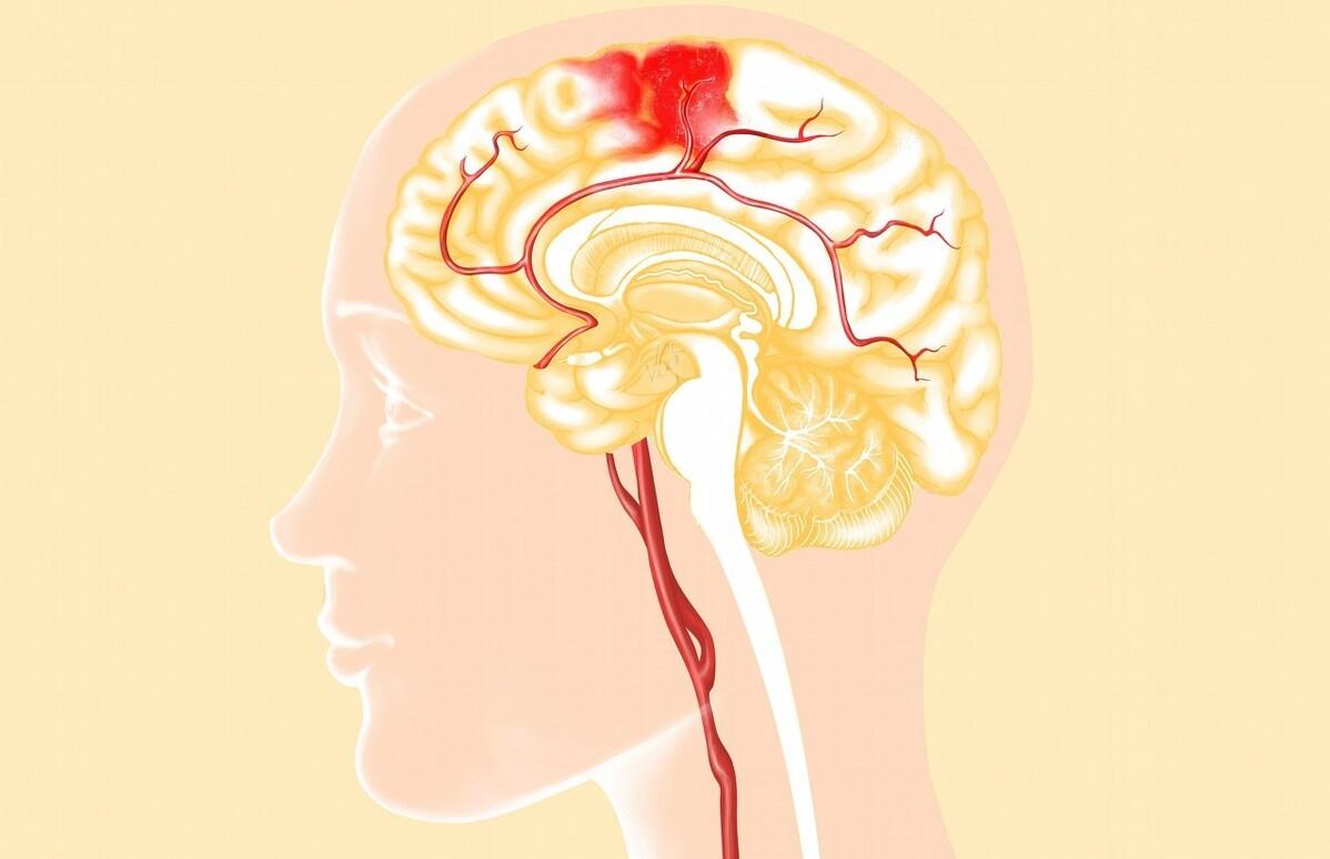 高血压脑出血急救最快的方法,血压高突发脑出血怎么治疗30岁