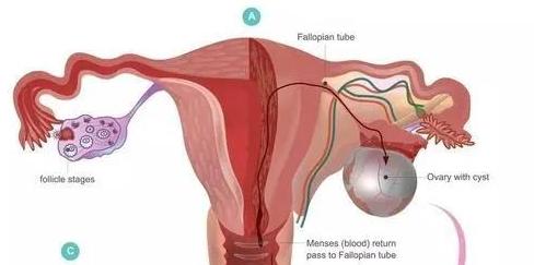 卵巢畸胎瘤和巧克力囊肿,未婚女性卵巢巧克力囊肿