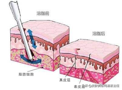 溶脂针一针能瘦身吗,瘦手臂溶脂针多少钱一针会反弹吗