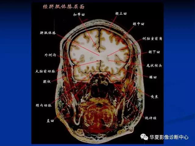 电子版头颅ct与mri断层解剖,头颅mri血管解剖与分段详解