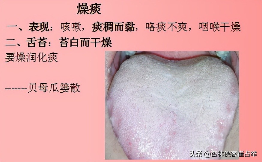 痰在肺则咳痰在胃则呕的意思,肺痰与胃痰