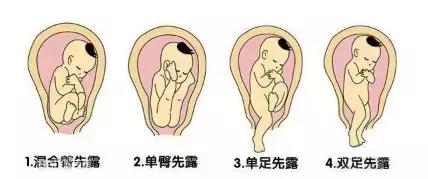 一个动作纠正胎位臀位,什么动作把胎位弄正