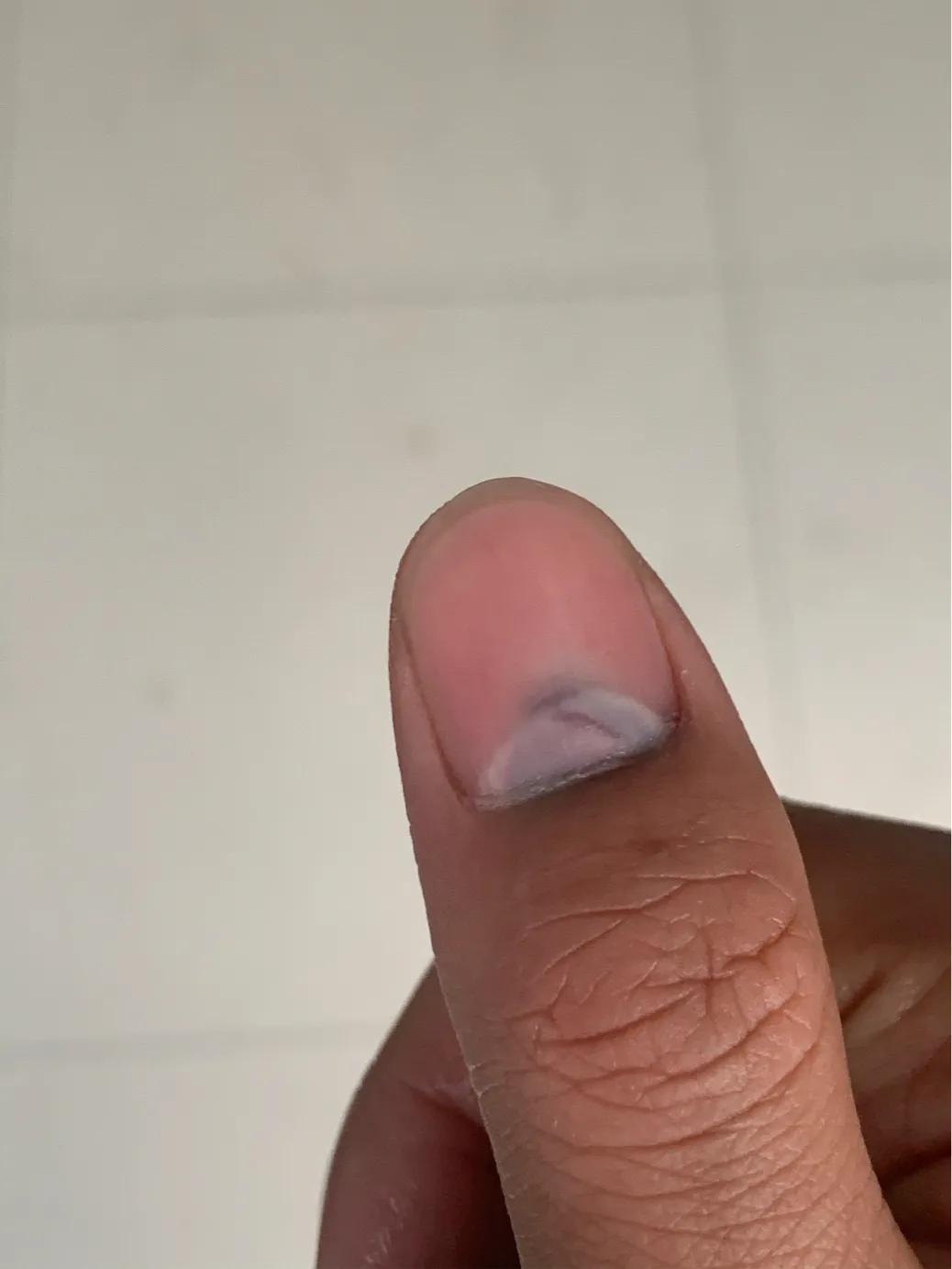 手指被夹出淤血该怎么办,手指被门夹淤血疼到睡不着