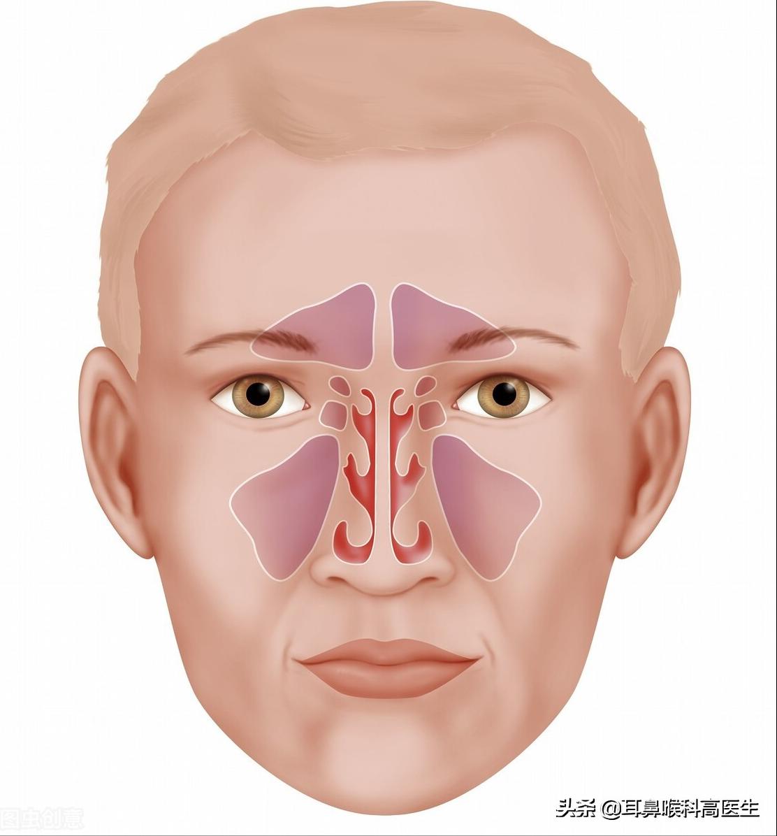 鼻窦炎为什么会头痛图解,鼻咽癌头痛和鼻窦炎头痛的区别