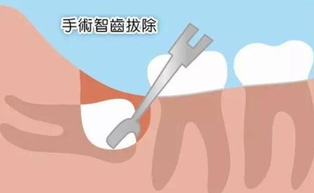 拔牙后出血不止小妙招,拔牙后出血不止怎么处理