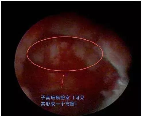 子宫憩室后遗症有哪些,子宫憩室手术治疗有哪些危害