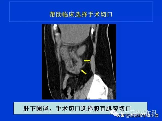 阑尾炎课件,阑尾炎的超声课件