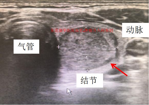 哈尔滨微创消融甲状腺结节哪家好,甲状腺结节微创消融术的过程