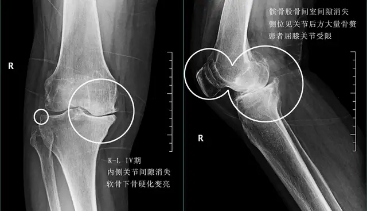 关节炎辟谣,膝关节滑膜炎辟谣