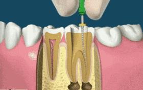 根管治疗后牙齿隐隐作痛怎么办,根管治疗后牙齿松动了怎么处理