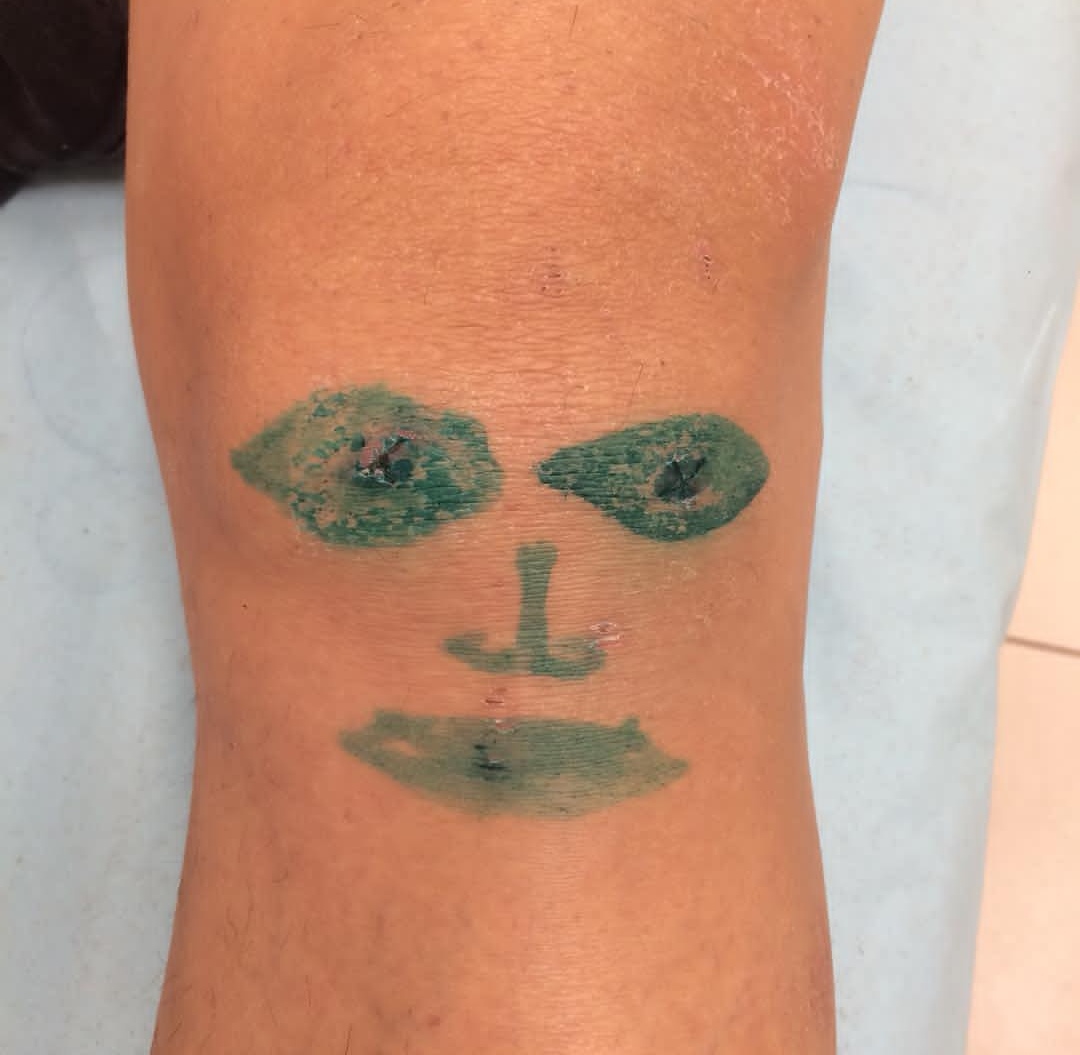 膝盖关节炎腿疼有什么好的方法吗,膝盖关节炎有骨刺怎么治疗