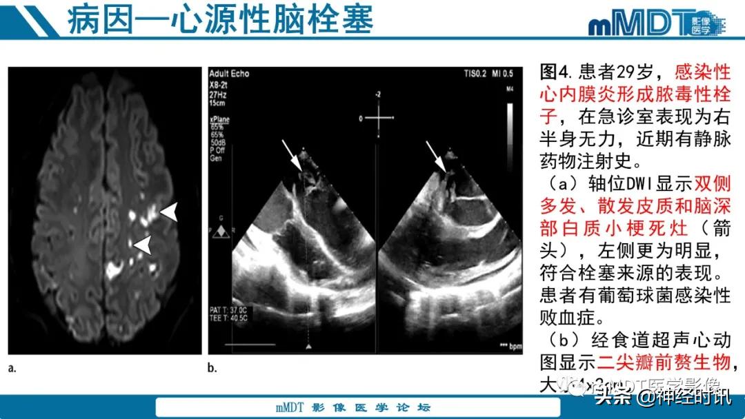 急性缺血性脑卒中ppt素材图片,青年缺血性脑卒中ppt